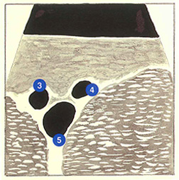 Figure 60B: Région inguinale (image échographique)