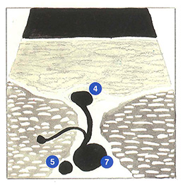 Figure 61B : Veines perforantes du canal de Hunter (perforante de Dodd).